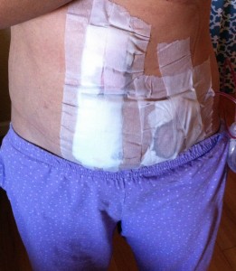 Diastasis Recti Surgery Photos 3 diastasis recti surgery before and after
