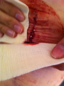 Diastasis Recti Surgery Photos 10 diastasis recti surgery before and after