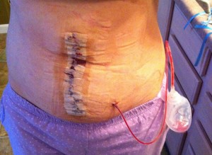 Diastasis Recti Surgery Photos 4 diastasis recti surgery before and after