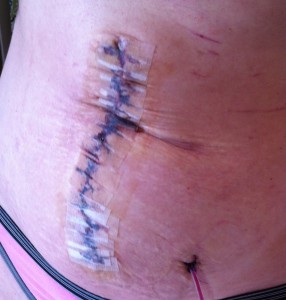 Diastasis Recti Surgery Photos 5 diastasis recti surgery before and after