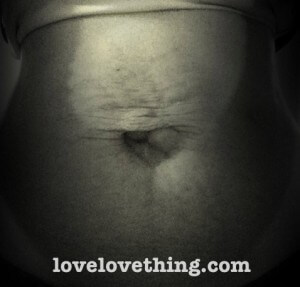 Diastasis Recti Surgery Series - Introduction 3 Diastasis Recti Surgery Series