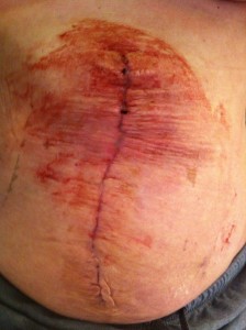 Diastasis Recti Surgery Photos 11 diastasis recti surgery before and after