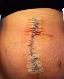 Diastasis Recti Surgery Photos 6 diastasis recti surgery before and after