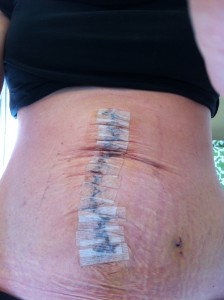 Diastasis Recti Surgery Photos 7 diastasis recti surgery before and after