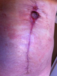 Diastasis Recti Surgery Photos 12 diastasis recti surgery before and after