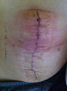 Diastasis Recti Surgery Photos 8 diastasis recti surgery before and after