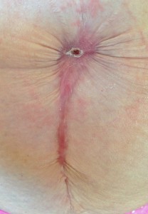 Diastasis Recti Surgery Photos 14 scar six months after diastasis recti surgery