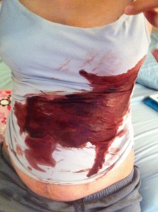 Diastasis Recti Surgery Photos 9 diastasis recti surgery before and after