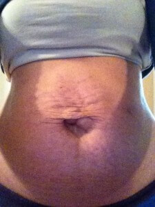 Diastasis Recti Surgery Photos 2 diastasis recti surgery before and after