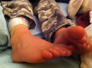 The GAPS Diet Comes to Town 3 Legs wrapped in bandages to prevent scratching in our second son. Eczema can break a mama's heart.