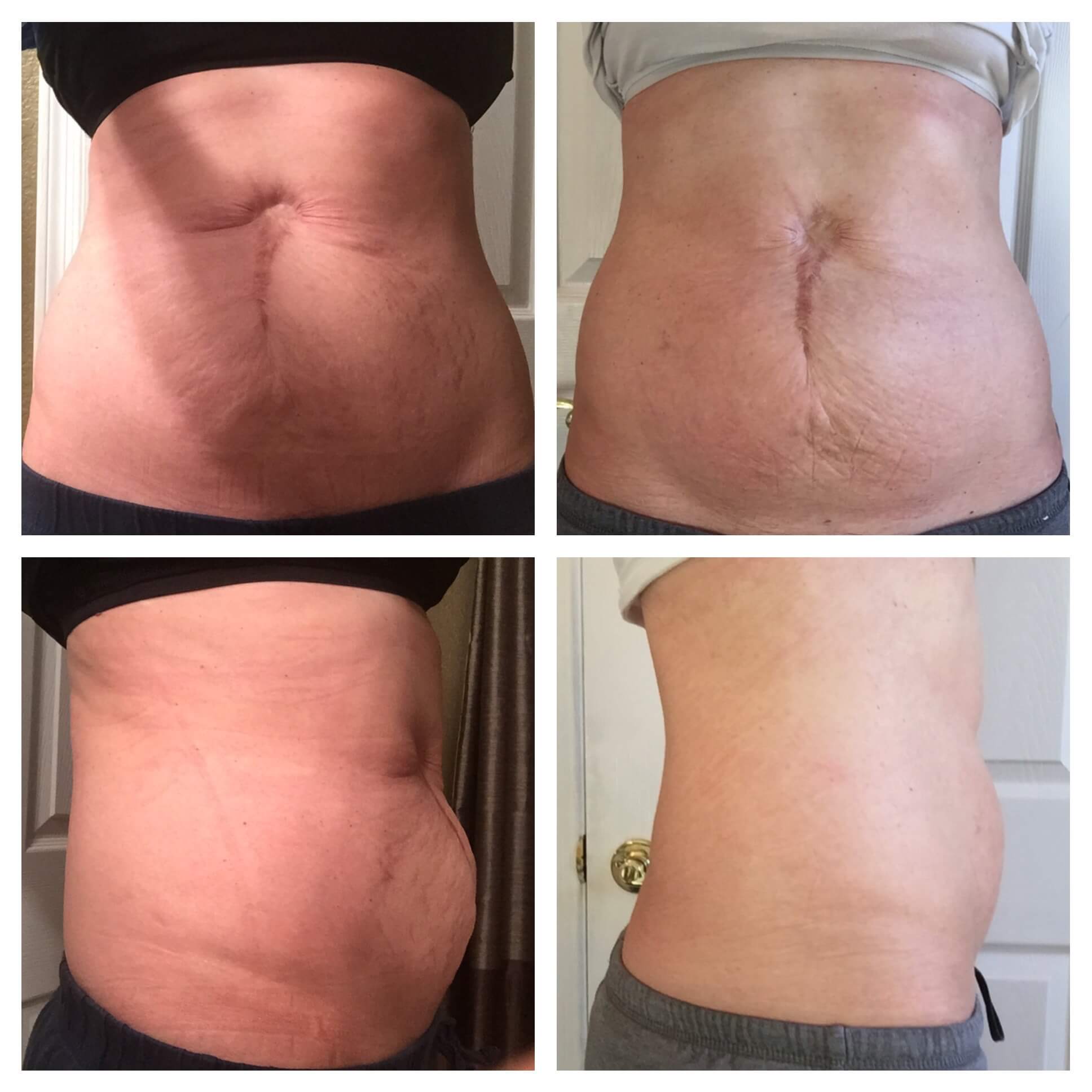 Diastasis Recti Surgery Update: 2 years later 3 Diastasis Recti Surgery Update