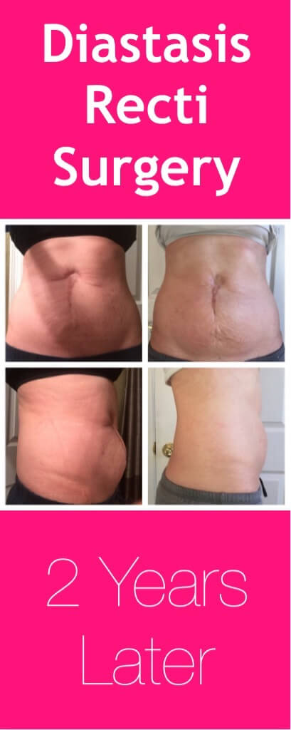 Diastasis Recti Surgery Update: 2 years later 4 Diastasis Recti Surgery Update: 2 Years later