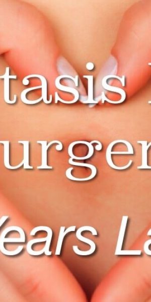 Diastasis Recti Surgery Update: 2 years later