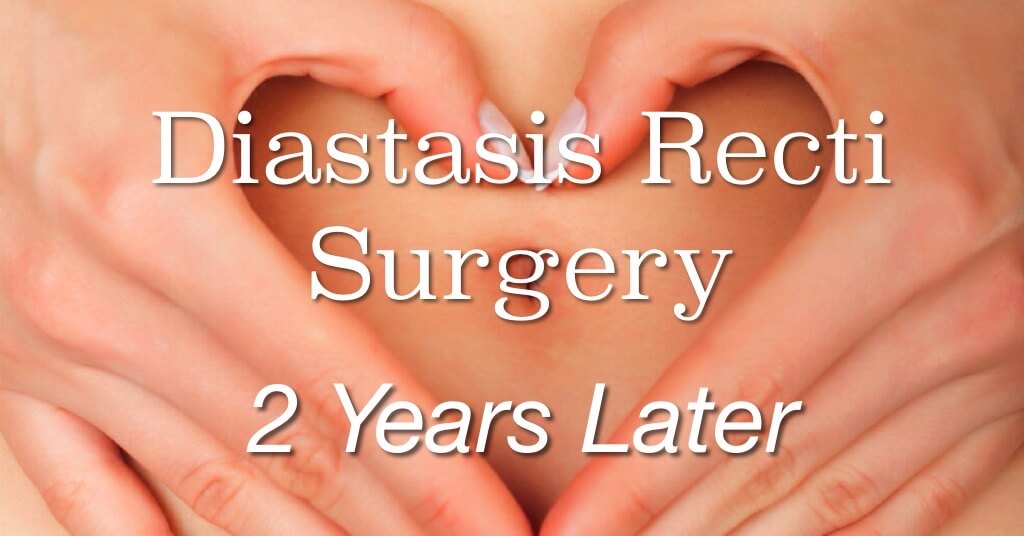 Diastasis Recti Surgery Update: 2 years later 2 Diastasis Recti Surgery Update: 2 Years Later